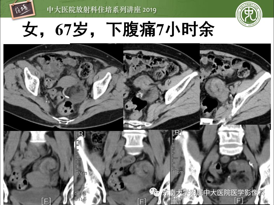 【PPT】卵巢急腹症影像学表现