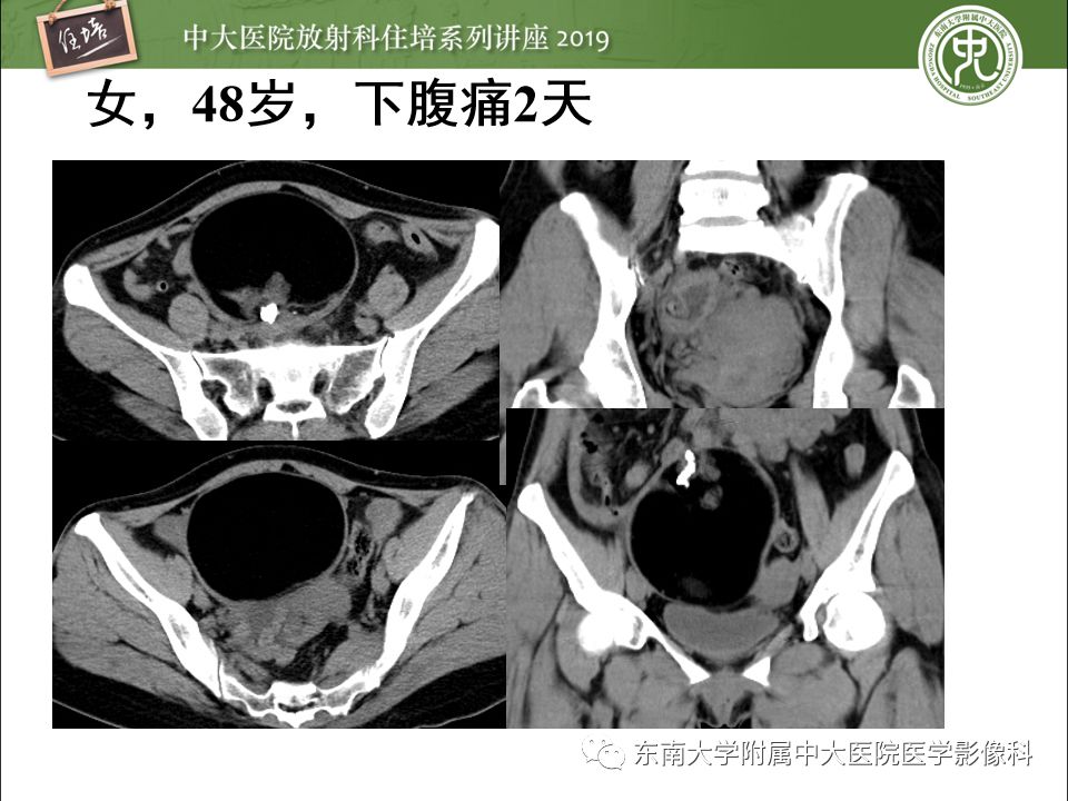【PPT】卵巢急腹症影像学表现