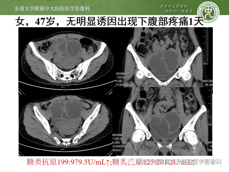 【PPT】卵巢急腹症影像学表现