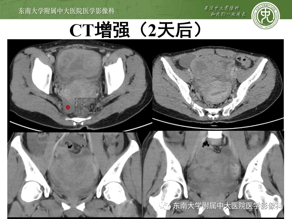 【PPT】卵巢急腹症影像学表现
