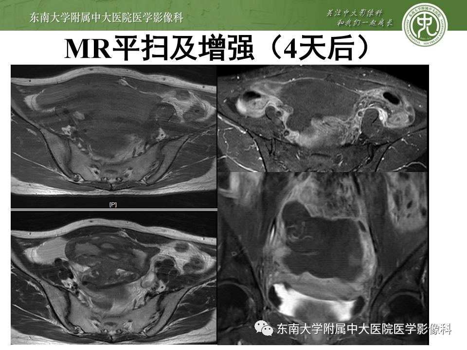 【PPT】卵巢急腹症影像学表现