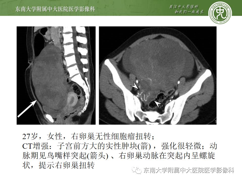 【PPT】卵巢急腹症影像学表现