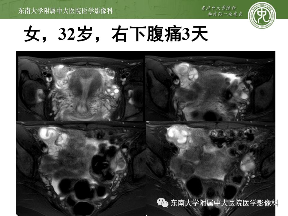 【PPT】卵巢急腹症影像学表现