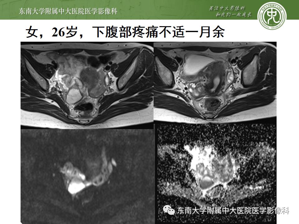 【PPT】卵巢急腹症影像学表现