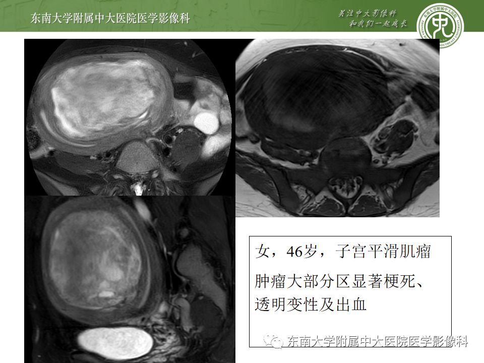 【PPT】卵巢急腹症影像学表现