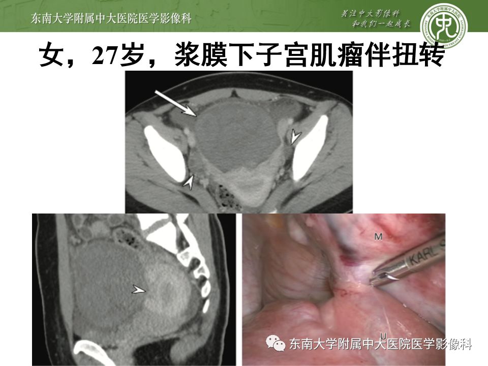 【PPT】卵巢急腹症影像学表现