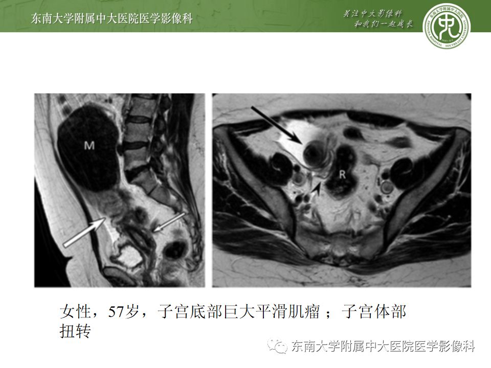 【PPT】卵巢急腹症影像学表现