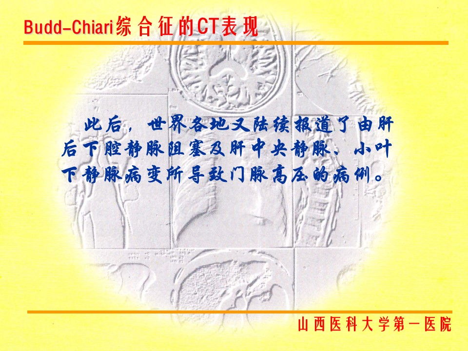 布加综合征CT表现
