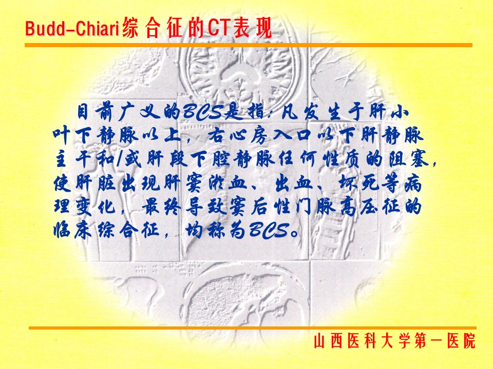 布加综合征CT表现