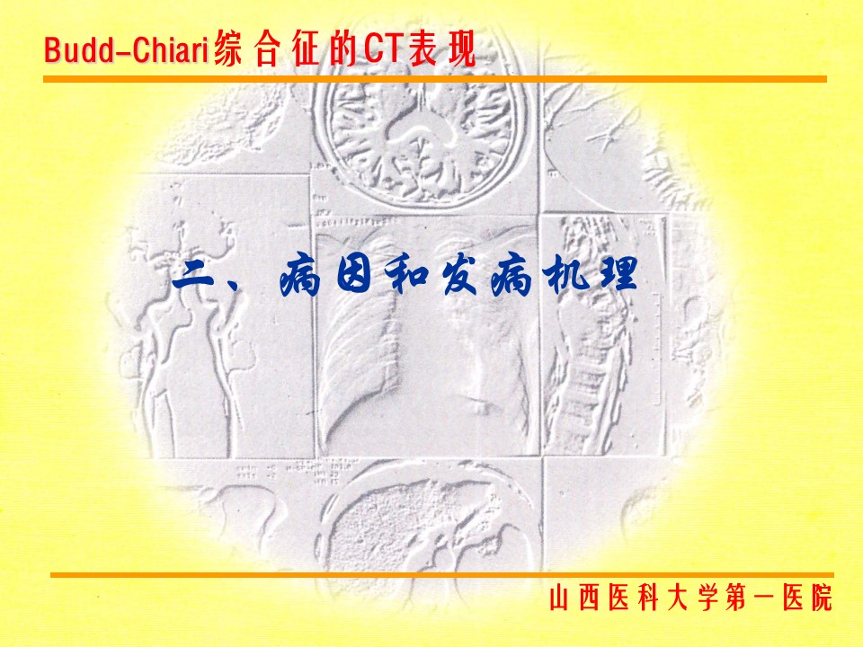 布加综合征CT表现