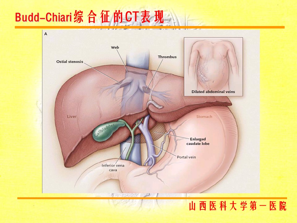 布加综合征CT表现