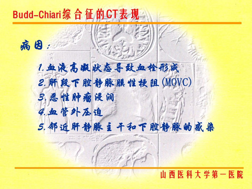 布加综合征CT表现