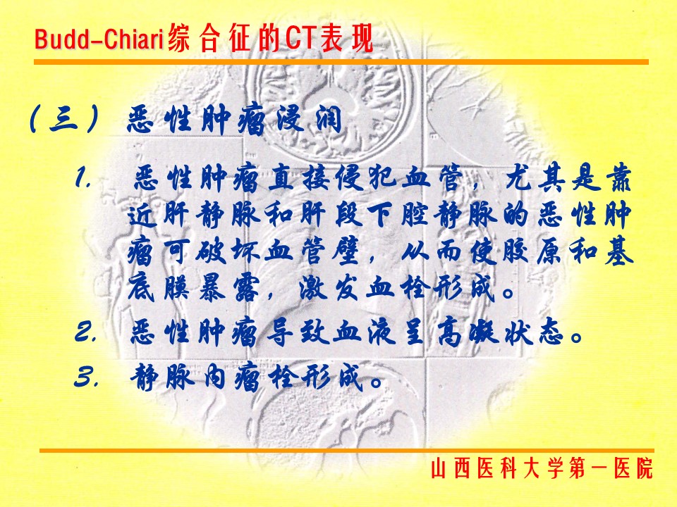 布加综合征CT表现