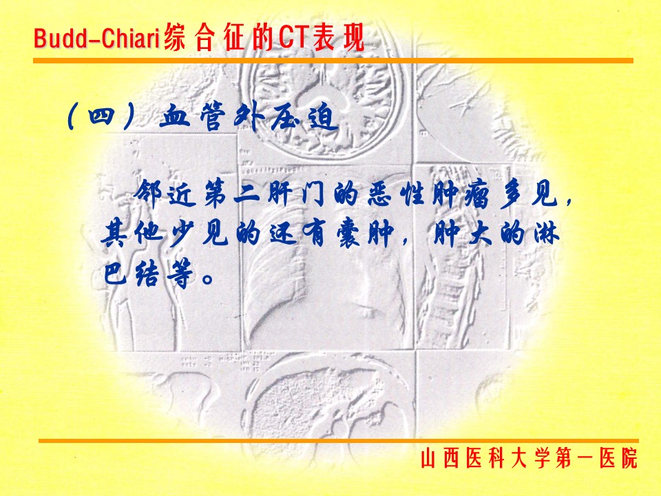 布加综合征CT表现
