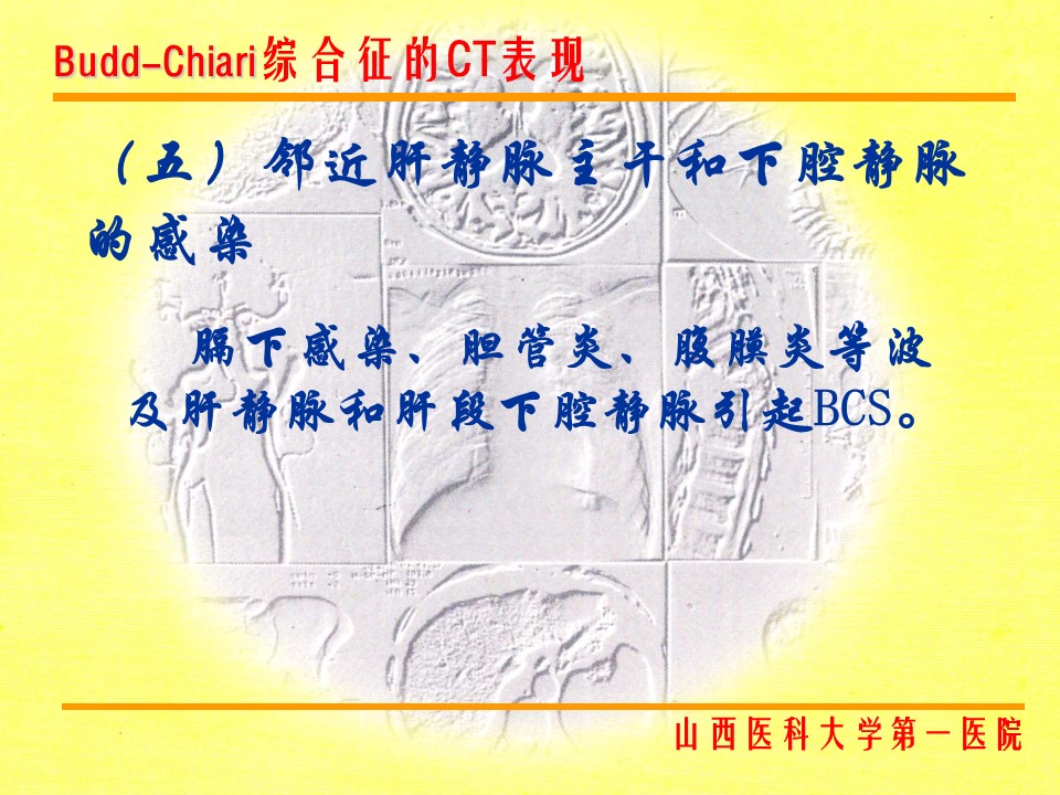 布加综合征CT表现
