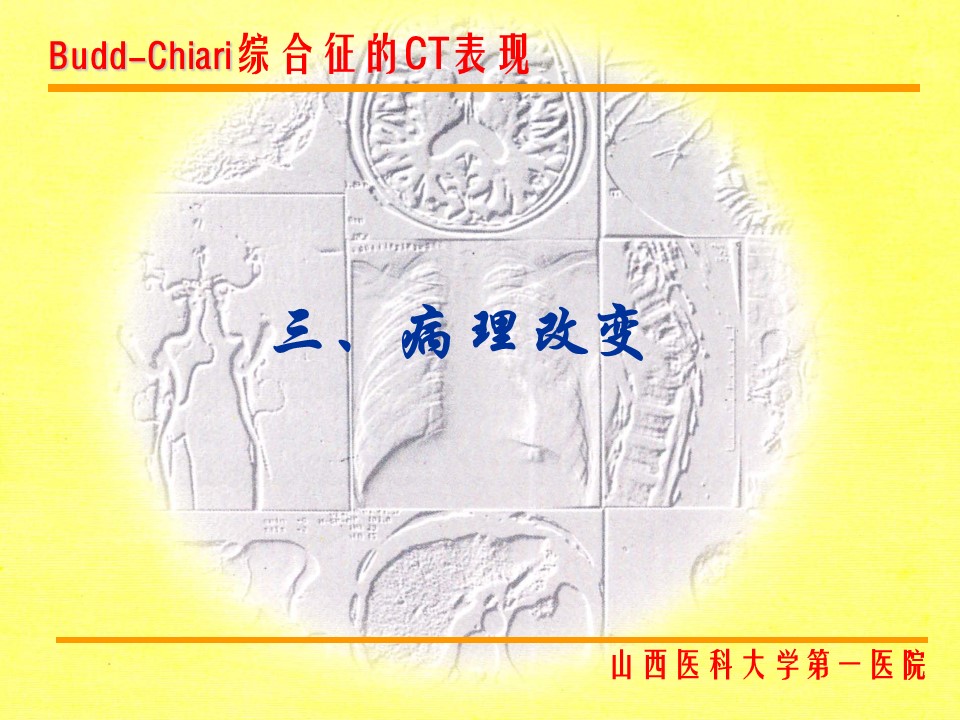 布加综合征CT表现