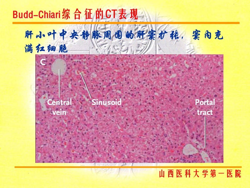 布加综合征CT表现