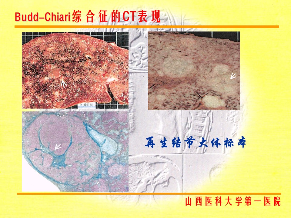 布加综合征CT表现