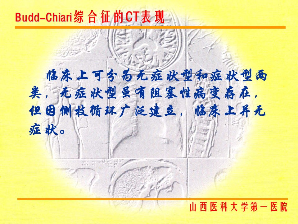 布加综合征CT表现