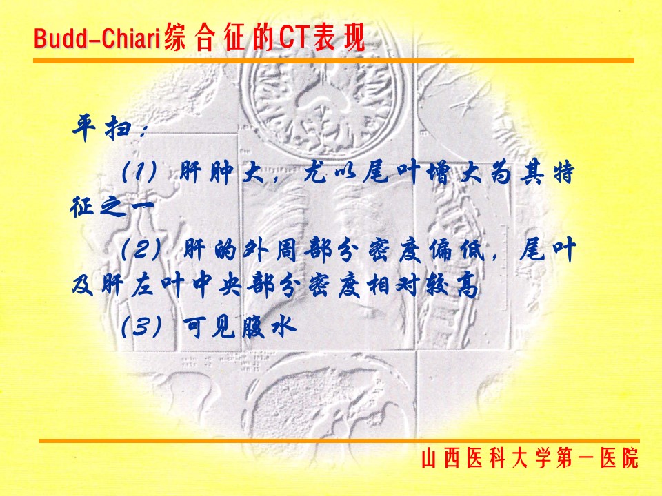 布加综合征CT表现