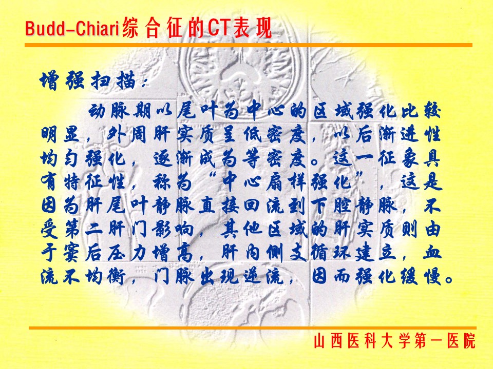 布加综合征CT表现