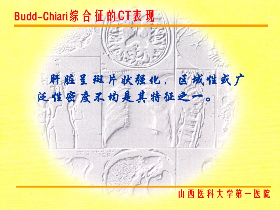 布加综合征CT表现