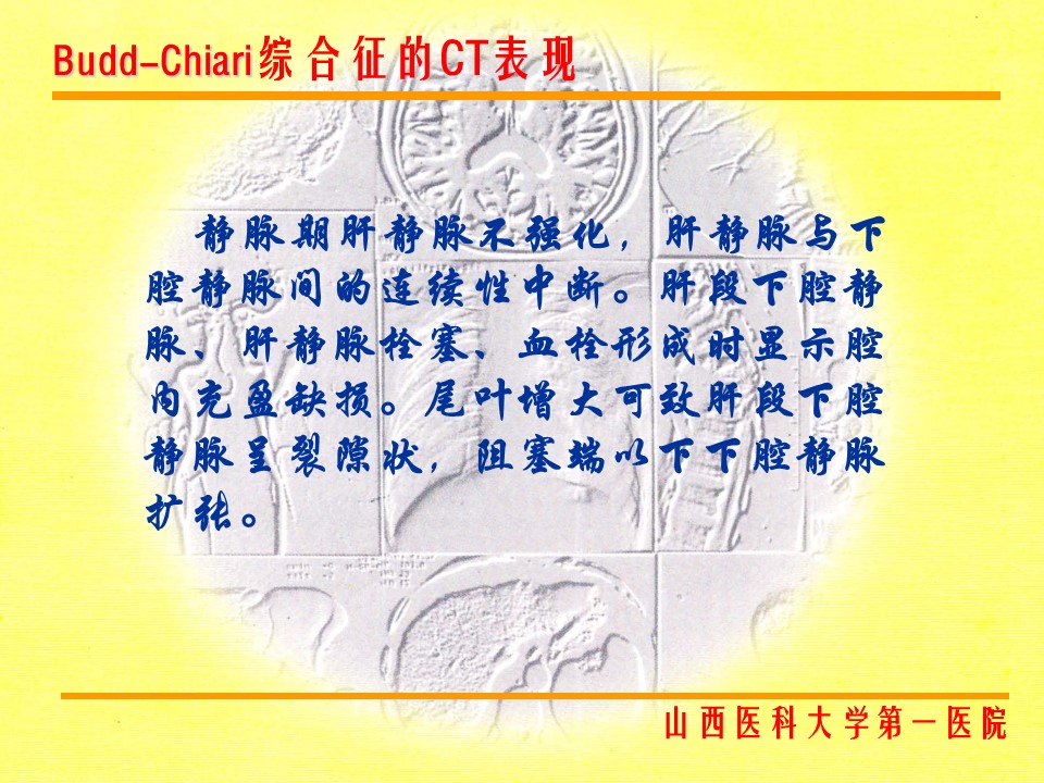 布加综合征CT表现
