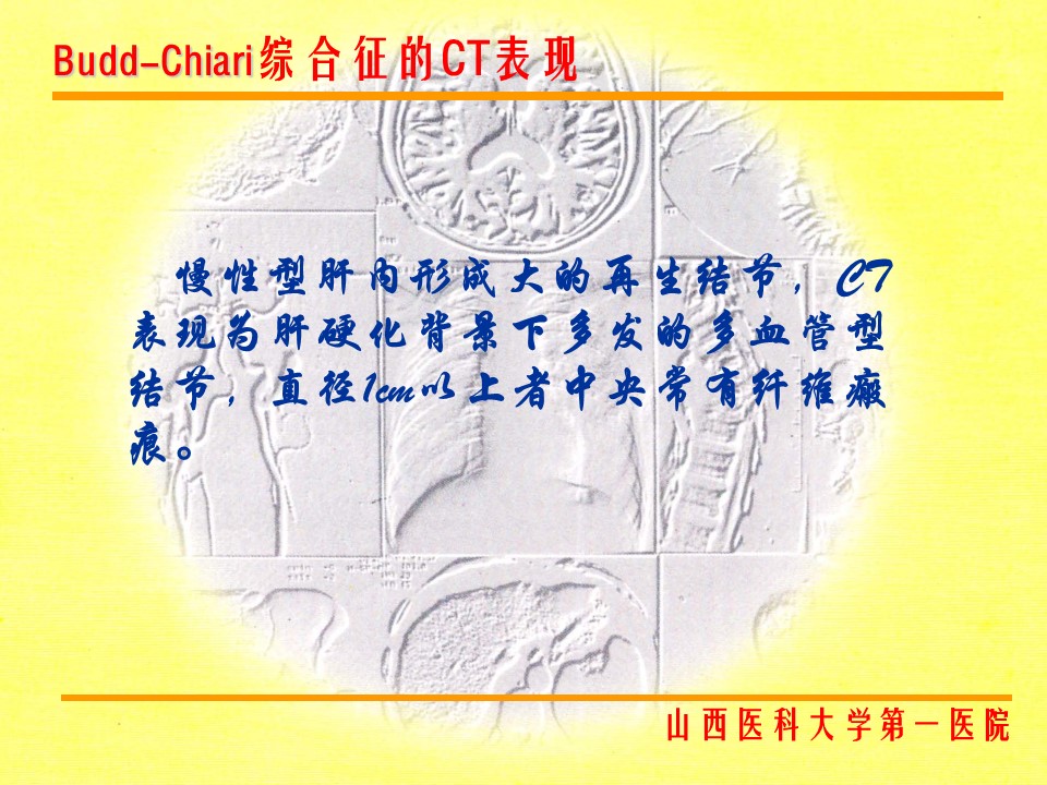 布加综合征CT表现
