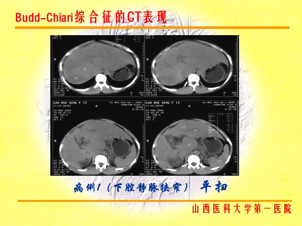 布加综合征CT表现