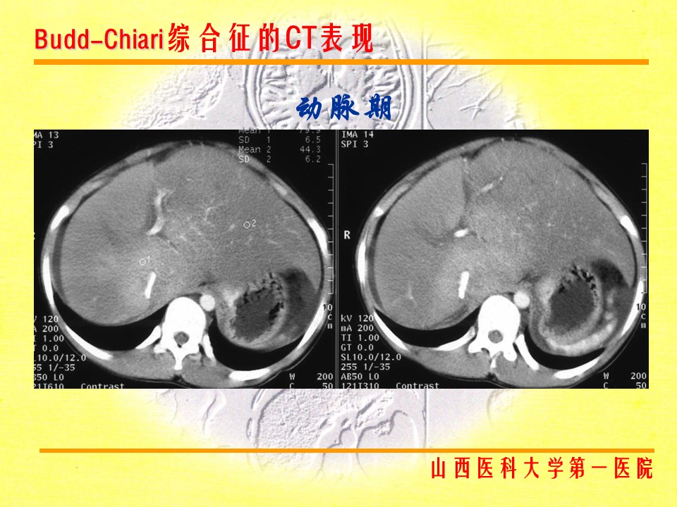 布加综合征CT表现