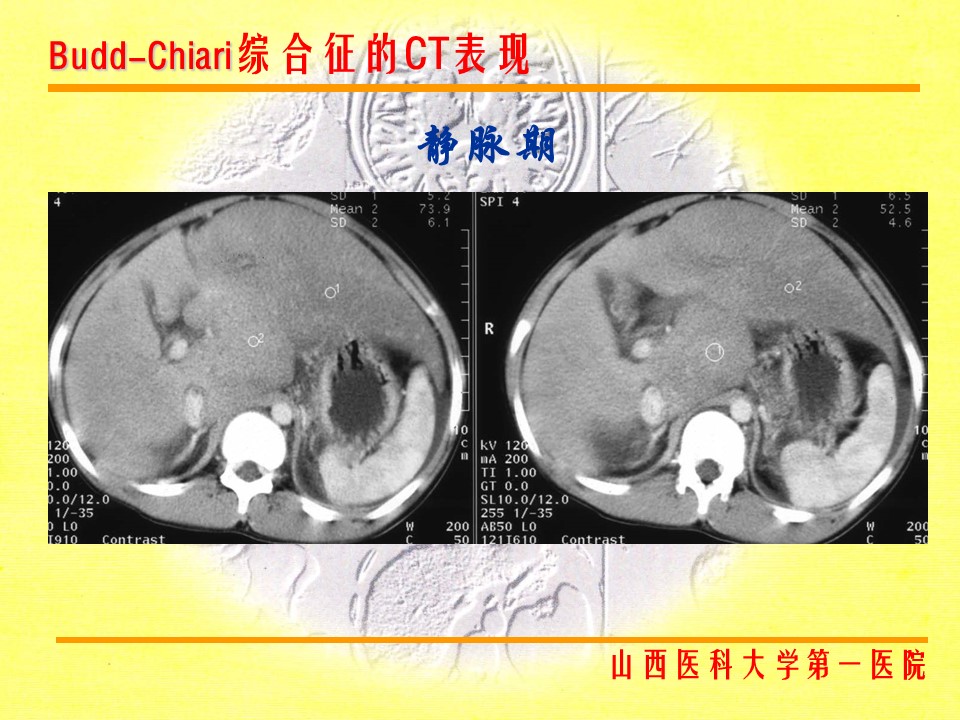 布加综合征CT表现