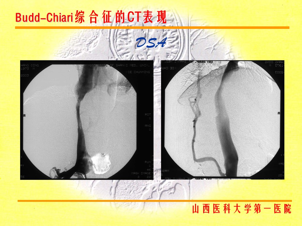 布加综合征CT表现