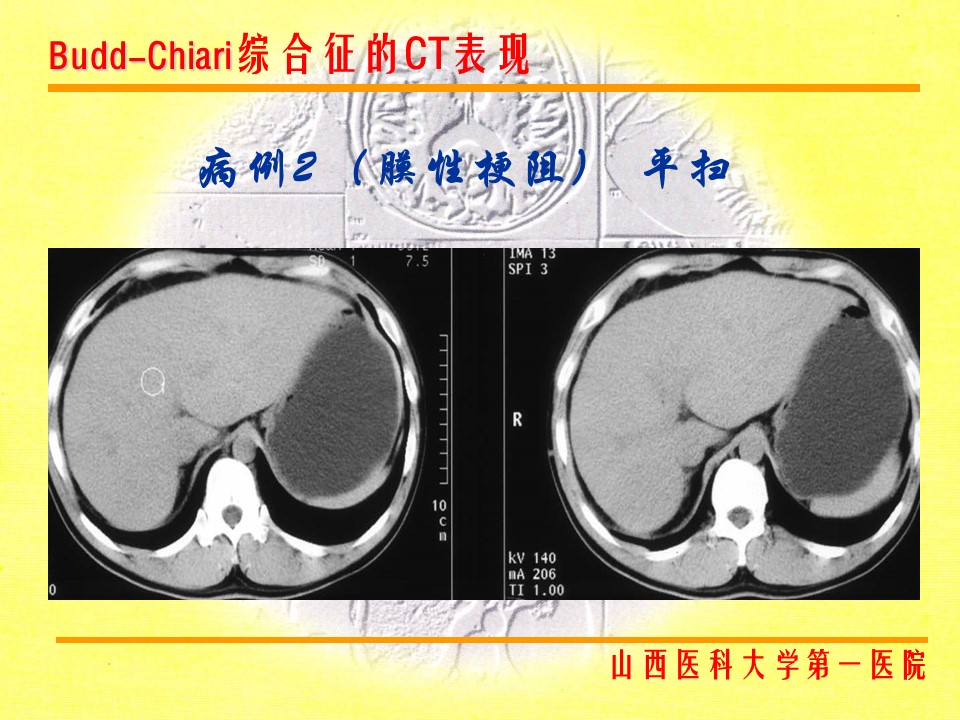 布加综合征CT表现