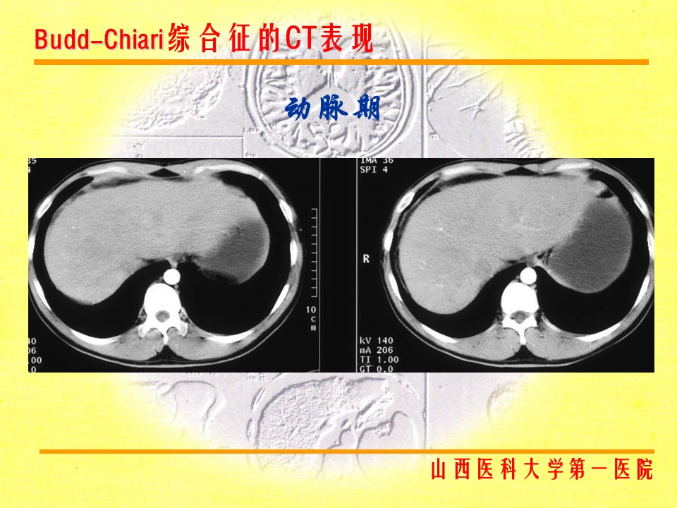 布加综合征CT表现