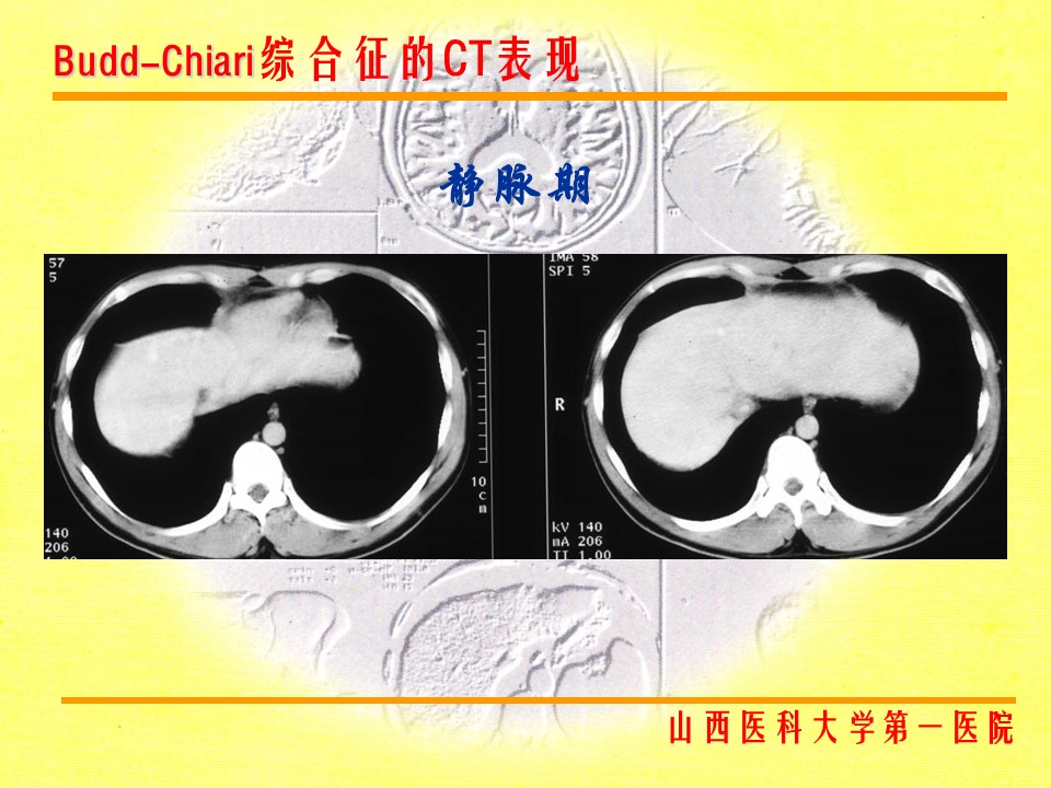 布加综合征CT表现