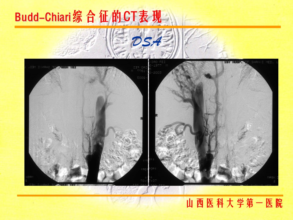 布加综合征CT表现