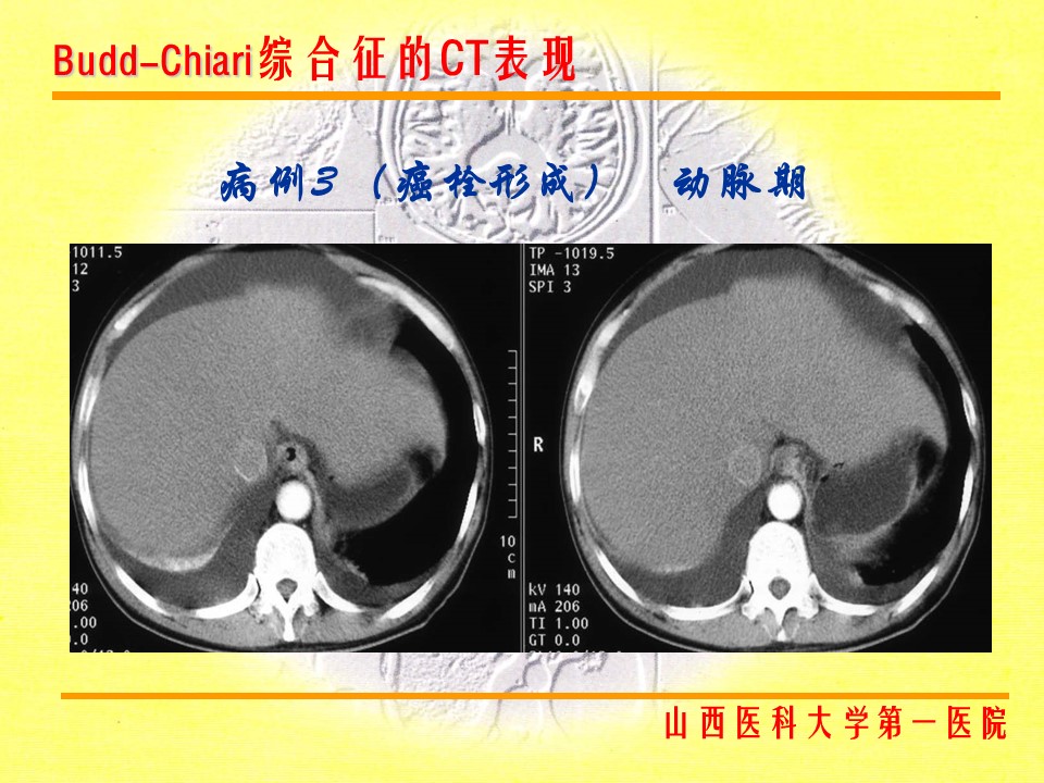 布加综合征CT表现