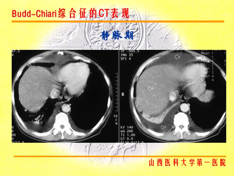 布加综合征CT表现