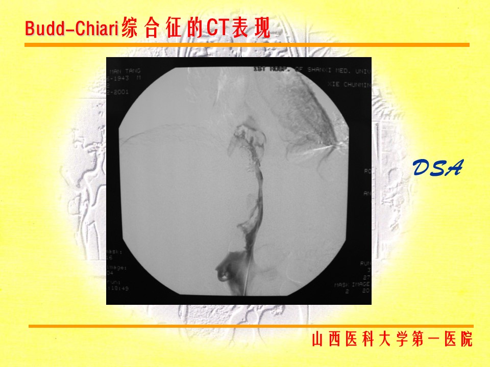 布加综合征CT表现