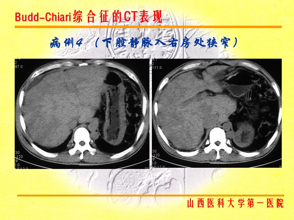 布加综合征CT表现