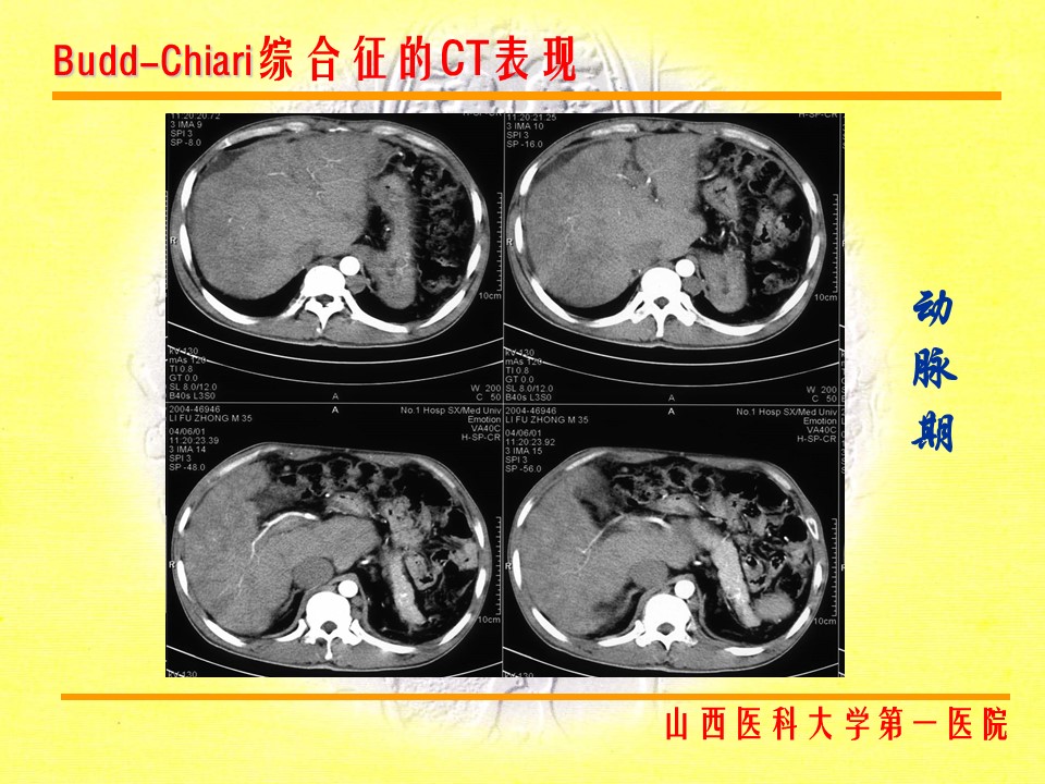 布加综合征CT表现