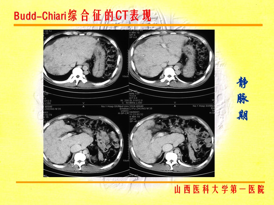 布加综合征CT表现