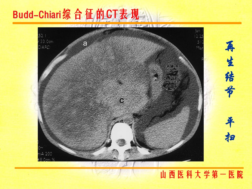 布加综合征CT表现