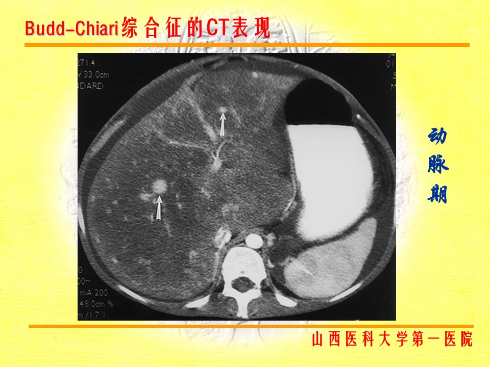 布加综合征CT表现