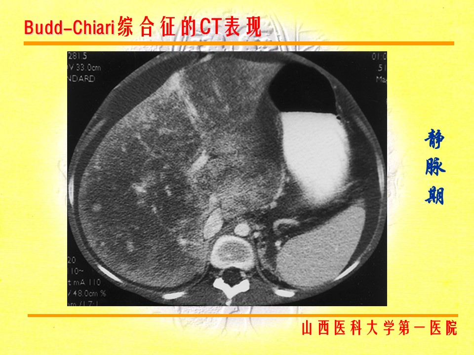 布加综合征CT表现