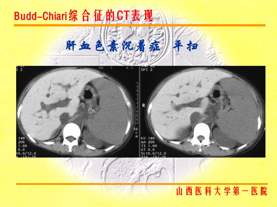 布加综合征CT表现