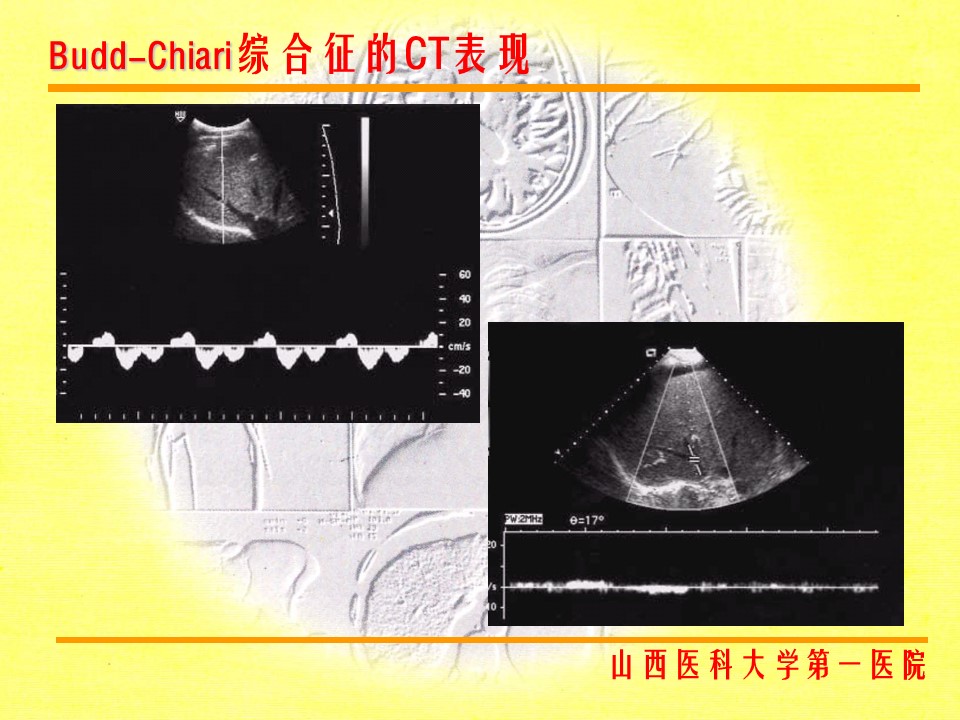 布加综合征CT表现