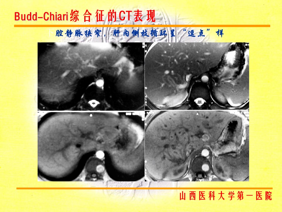布加综合征CT表现