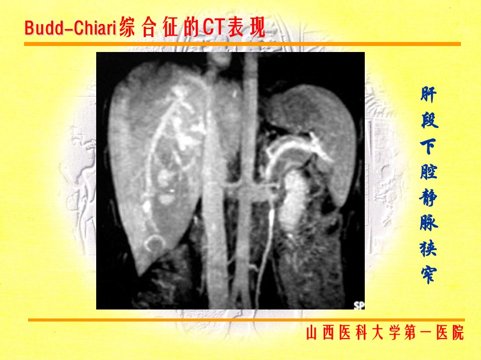 布加综合征CT表现