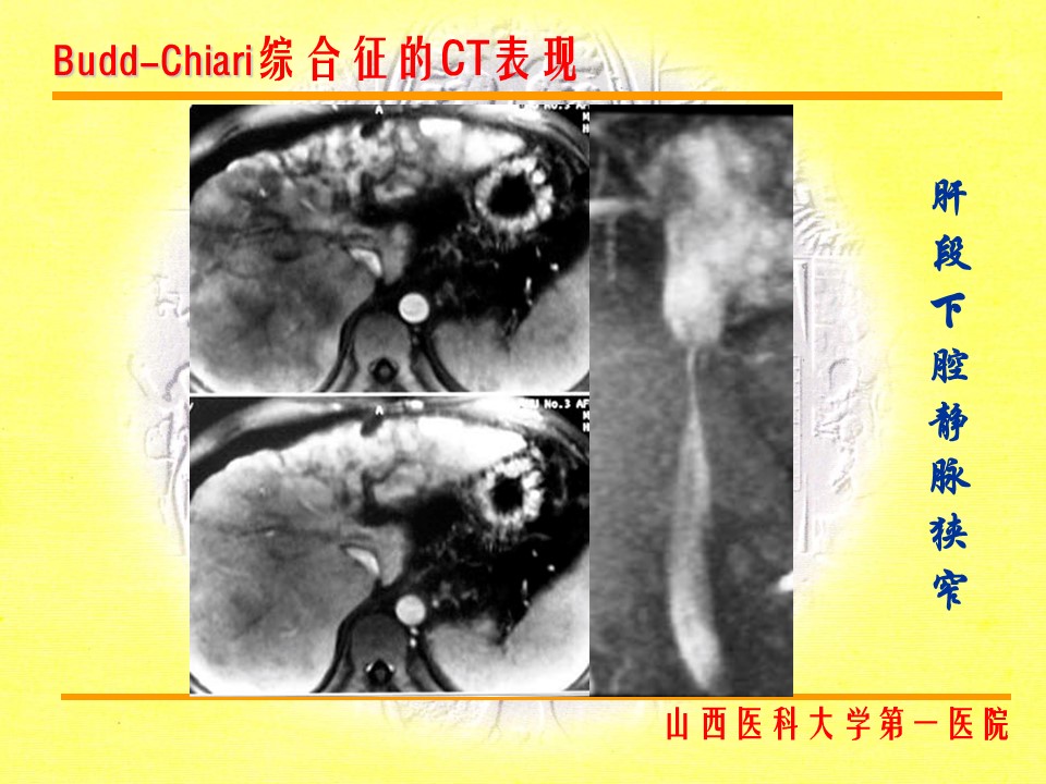 布加综合征CT表现